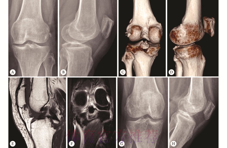 皇马官方:巴斯克斯左膝后交叉韧带扭伤 皇马官方:巴斯克斯左膝后交叉韧带扭伤